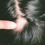 Photobiomodulation et alopécie androgénétique chez l'homme : efficacité comparée